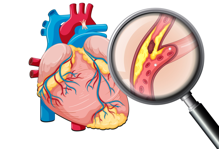 Aortic Aneurysm: Types, Causes, Symptoms, and Risk Factors